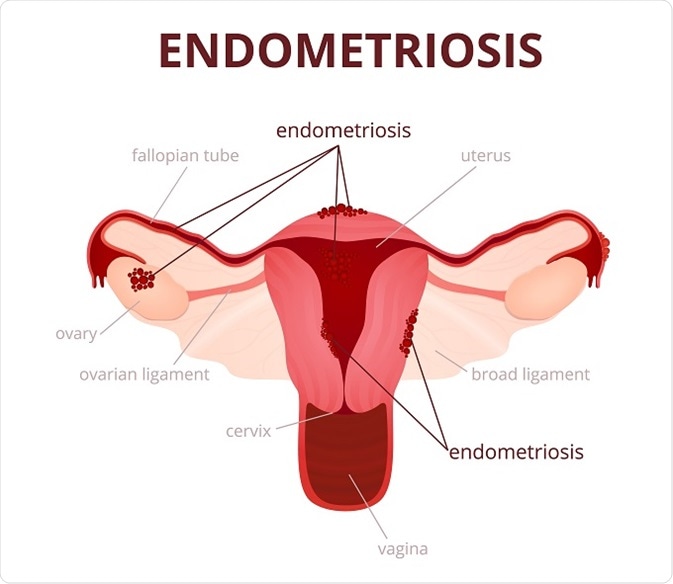 Endometriose, onvruchtbaarheid en histamine